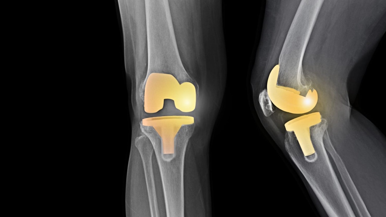 Knee Arthroplasty Large