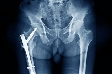 orthogeriatrics-vasilis fotopoulos-athina-1