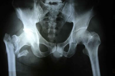 orthogeriatrics-vasilis fotopoulos-athina-2