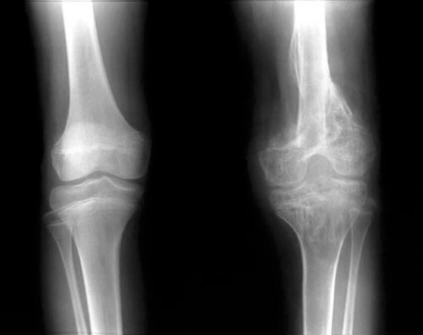 Ορθοπαιδικές Λοιμώξεις