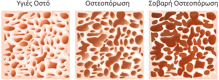 osteoporosi-fotopoulos