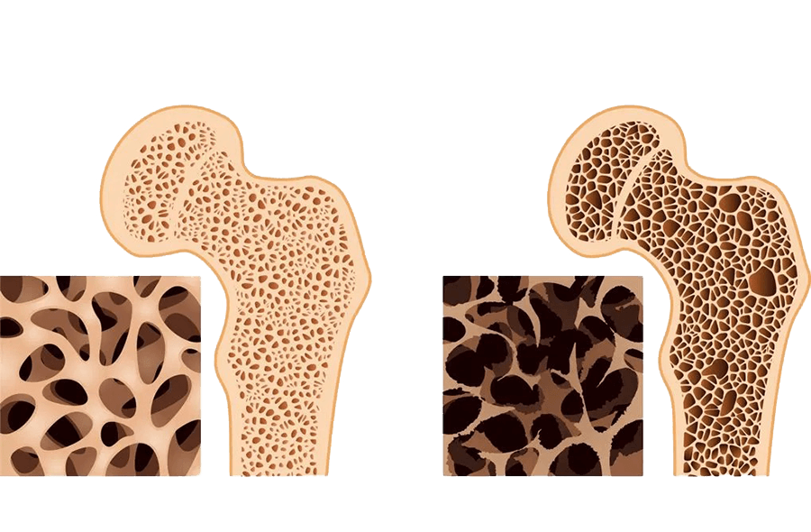 symptomata-osteoporosis-vasilis-fotopoulos